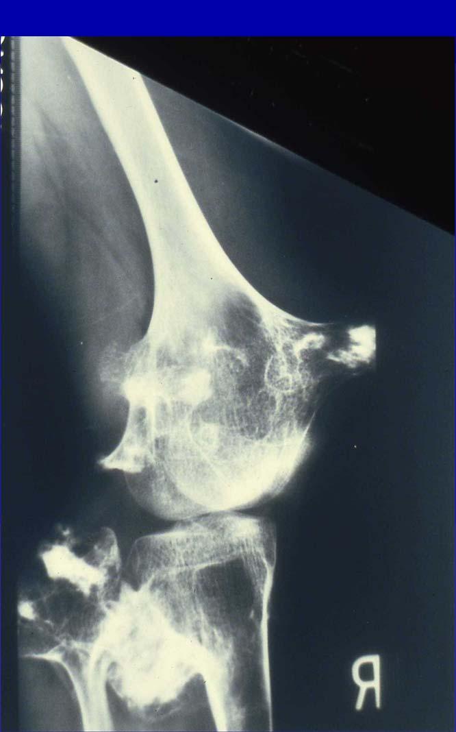Osteochondroma Clinical: Obvious mass lesion;