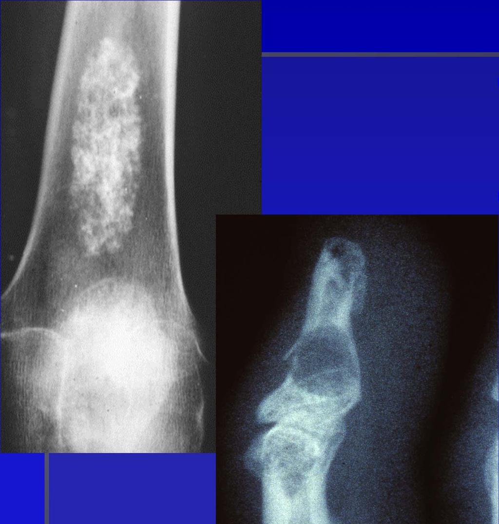 Enchondroma-Radiology Variable intralesional calcification Rings and arcs