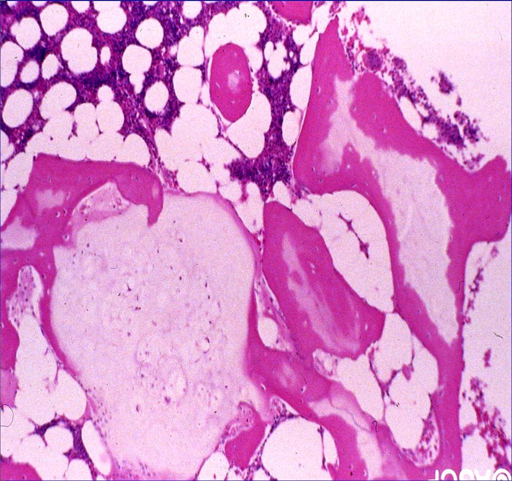Enchondroma Histopathology: Circumscribed, lobulated lesion comprised of