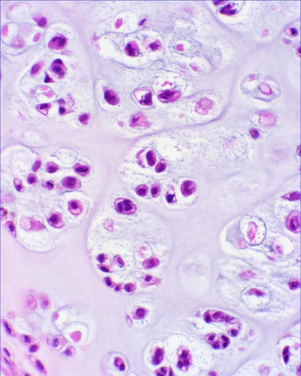 Enchondroma Peripheral concentration of chondrocytes Minimal cytologic atypia