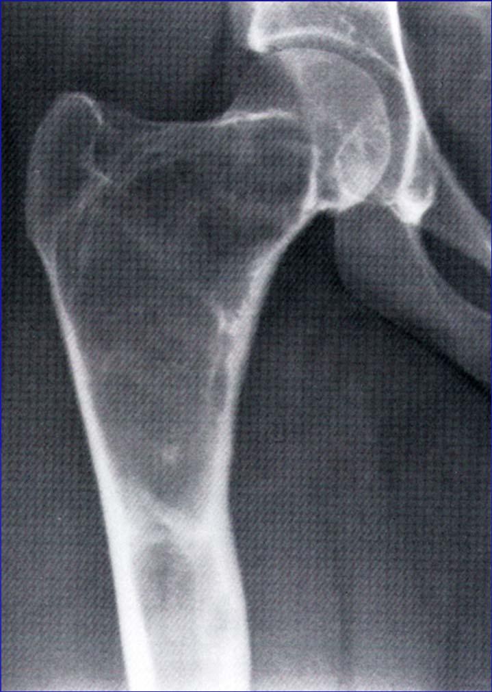 Fibrous dysplasia Radiologic: Metaphyseal or diaphyseal based lesion Lytic or ground glass