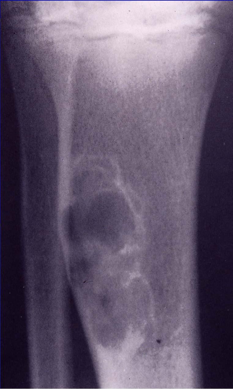 Fibroma/NOF Rad: sharply demarcated, expansile lesion of the