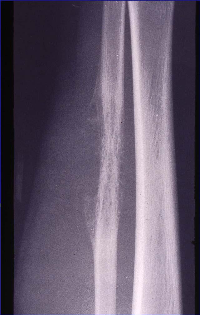 Ewing Sarcoma Radiologic: Extensive, poorly marginated diaphyseal lesion Periosteal new bone