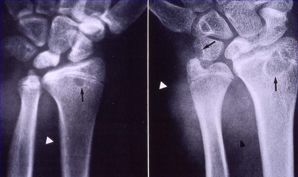 PVNS Periarticular soft tissue swelling and mass effect Extensive bone