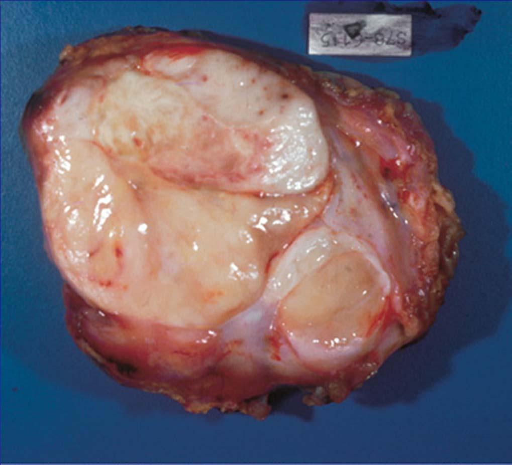 Liposarcoma One of the more common sarcomas Develop in the deep soft tissue; thigh and