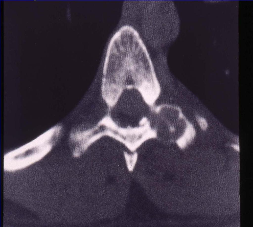 Osteoblastoma Radiology: may simulate osteoid osteoma but can be highly variable in