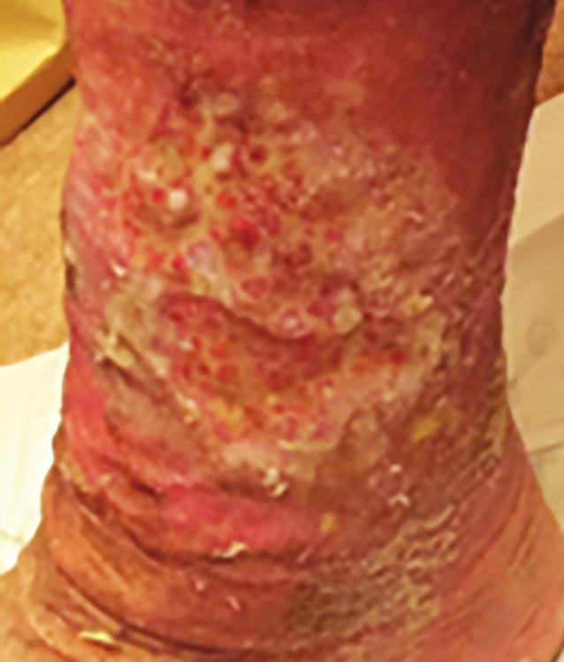 CASE STUDY 2 Figure 1. Wound at presentation (8/12/16). An 85-year-old female presented with a non-healing venous leg ulcer of 9 weeks duration.