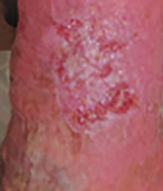 Following three weeks of treatment with LQD, the wound was no longer sloughy, there was improvement in the surrounding skin and the wound was reducing in size (Figure 2). Figure 3.