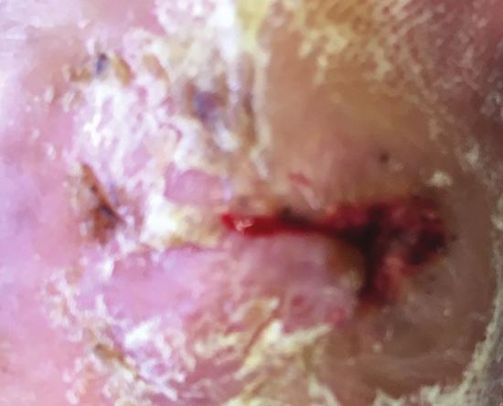 CASE STUDY 3 A 70-year-old male with a history of diabetes and peripheral vascular disease presented with a small troublesome ulcer of 850 days duration.