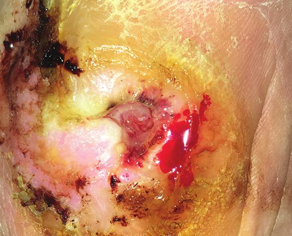 At the end of the evaluation, the wound was 100% granulating and was almost healed and the condition of the surrounding skin had improved (Figure 2). Figure 1. Wound at presentation (13/7/17).