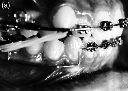 The anterior arch (0.022-inch Truchrome; Rocky Mountain Orthodontics) was adjusted to insert passively into incisor brackets. The posterior 0.
