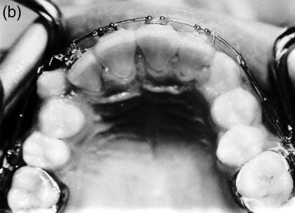 045 inches; Rocky Mountain Orthodontics) 5 mm in length, were inserted between the Omega adjustable stops and buccal tube.