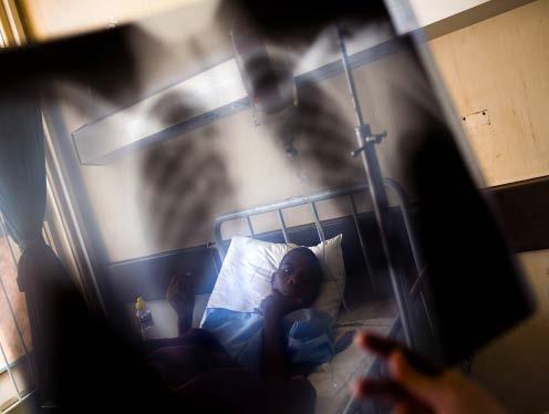 Human & Economic Toll GLOBAL of TB VACCINE in South FOUNDATION Africa South Africa is among the top 5 countries in the world with the highest number of TB cases More than one-third of the