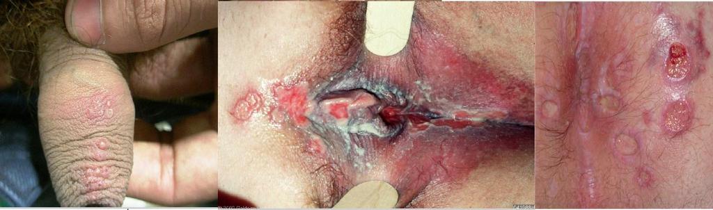 Sarrera Genitaletan HSB2aren infekzioak sorrarazitako lesioak ezin dira HSB1ak eragindakoengandik bereizi [37]; lesio horietako makula eta papula formetatik xixkuak garatzen dira eta hauek apurtu