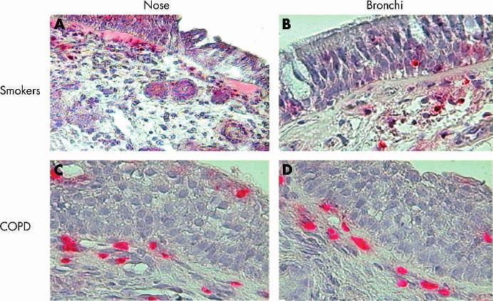 306 Vachier, Vignola, Chiappara, et al Figure 1 CD8 T lymphocyte immunoreactivity of nasal (A, C) and bronchial biopsies (B, D) from smokers with (C, D) and without (A, B) COPD.