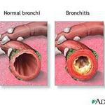 What is COPD? Progressive lung diseases Chronic bronchitis, emphysema, refractory asthma, some forms of bronchiectasis Airways partially blocked Photo Credit: Photo A.