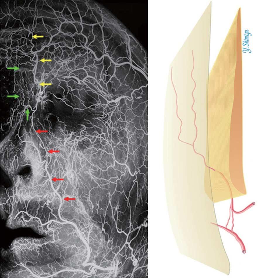 A B Skin Muscle layer Supratrochlear artery Angular artery Figure 1. The arterial anatomy of the face is shown on the left. The soft tissues were raised on the periosteum.
