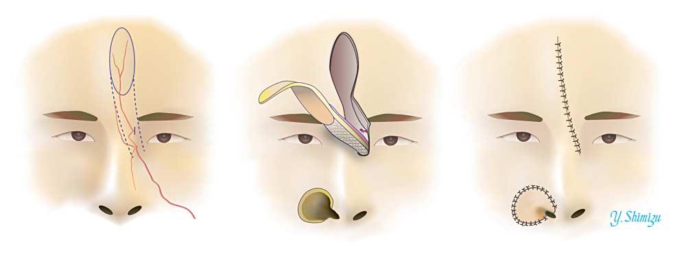 Figure 2. A schematic view of the paramedian forehead flap based on the angular artery is shown. The supratrochlear artery is dissected. A B C Figure 3. Case 1.