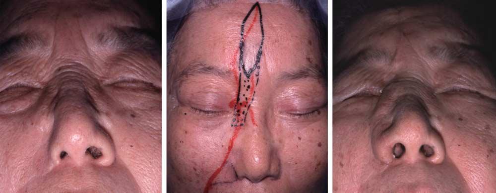 A B C Figure 4. Case 2. A 73-year-old woman had a basal cell carcinoma on her right ala, and the lesion had been resected and primarily sutured at another hospital.