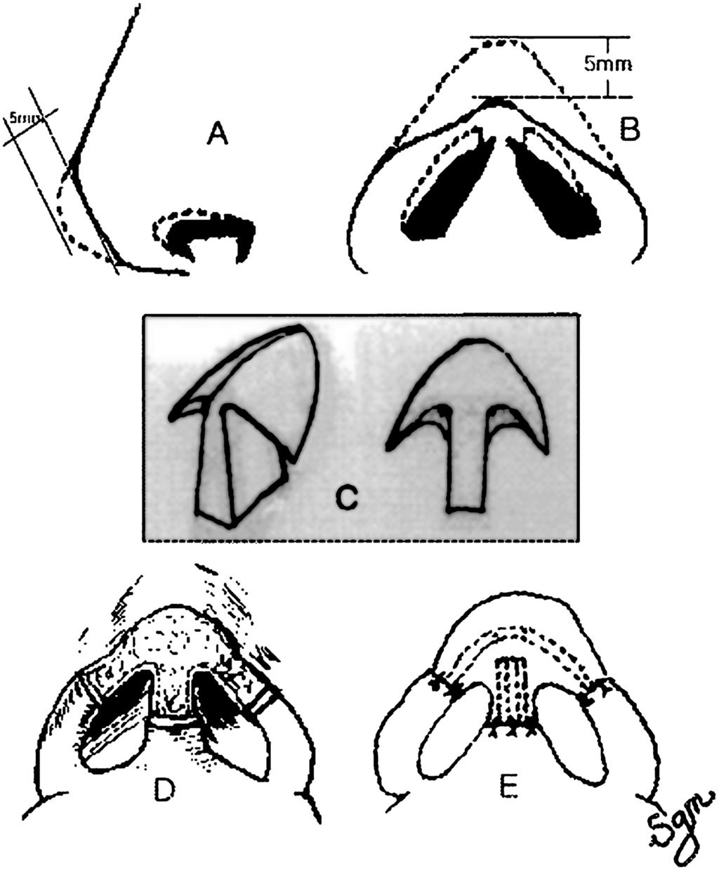 Aesthetic reconstruction of the nasal tip using a folded composite graft from the ear 241 Figure 3 Diagram (A and B) shows pre-operative status and expected status after reconstruction (dotted line).