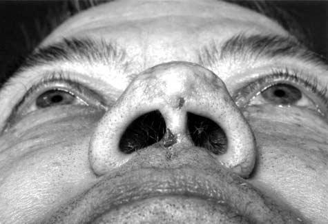 Figure 5. Basal cell carcinoma of the columella. Figure 6. Tumor after resection. The dark marking on the upper lip signifies the area of full-thickness resection to close the lip defect primarily.