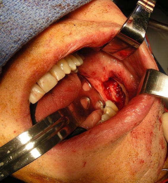 Rigid + Surgical plate fixation debridement