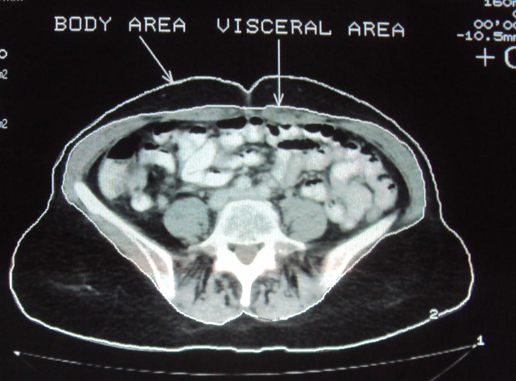 Fig. 2: Axial CT image at the level of the umbilucus: method of measurement body