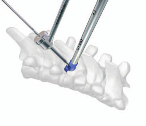 Check that the pedicle hook is snug around the pedicle by axial loading of the hook positioner and also by pushing laterally. Note: The pedicle hook is correctly placed when it can no longer be moved.