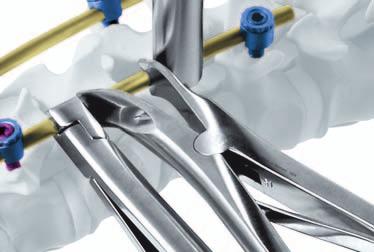 Distraction or compression of two adjacent implants Required instruments USS Spreader Forceps, length 330 mm 388.40 Compression Forceps for USS and Click'X 388.