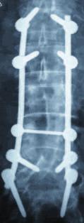 thoracolumbar spine: Thoracolumbar