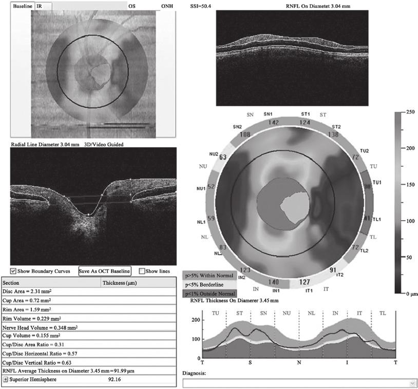 ZHANG et al: DIAGNOSTIC CAPABILITY OF FDOCT IN GLAUCOMA AND NAION 269 Figure 1. Diagram of procedure for optic nerve head () measurement by Fourier domain optical coherent tomography (OCT).