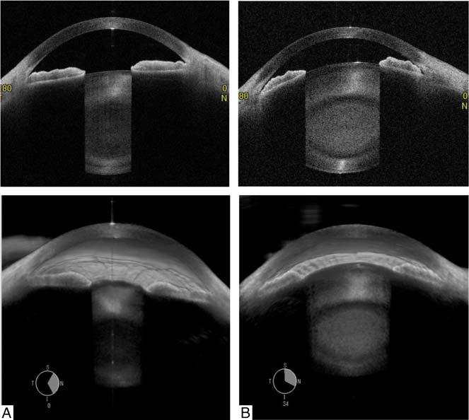 Leung Asia-Pacific Journal of Ophthalmology Volume 5, Number 1, January/February 2016 FIGURE 1.