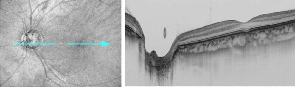 Notice the new swept-source OCT can capture the entire anterior segment from the anterior corneal surface to the posterior lens surface.