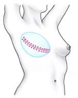 By waiting, the surgeon is better able to position the nipple accurately, in line with the one on the other breast.