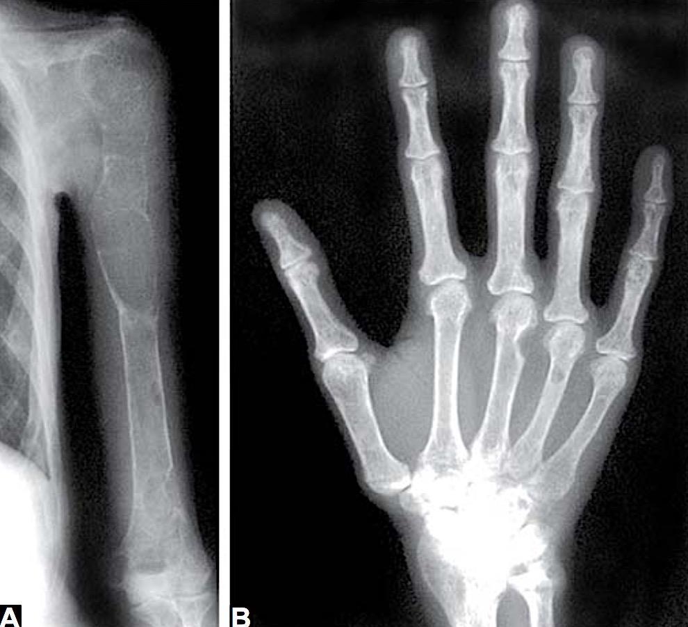 X-ray of humerus and hand: