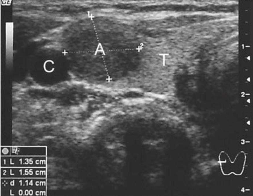 PREOPERATIVE LOCALIZATION OF GLANDS -HIGH FREQUENCY NECK ULTRASOUND 75 % of enlarged glands identified Non-invasive Cannot visualize mediastinum Ineffective in the