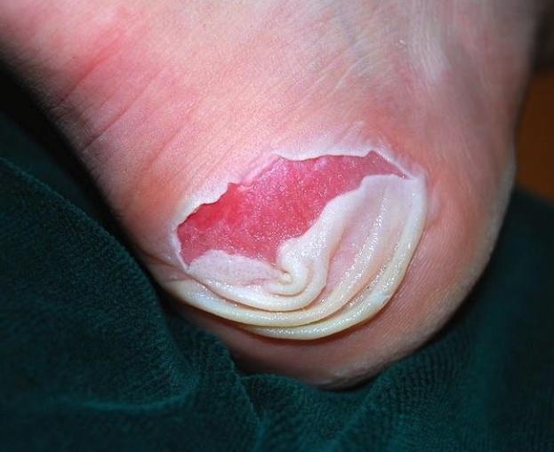 Mechanical Skin Trauma Blister: Separation of epidermis from dermis secondary to friction <1 cm