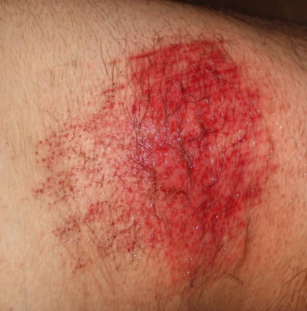 Abrasions Superficial skin wound Epidermis from dermis Examples: Road rash, turf burn, mat burn Cleanse abrasions: saline vs tap water,