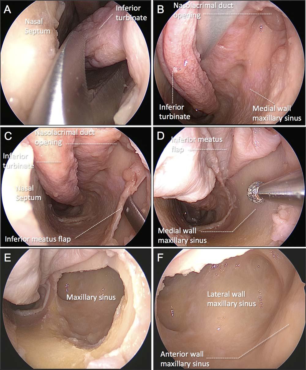 Fig. 1. Cadaveric dissection showing the steps of the transnasal endoscopic medial MS wall transposition approach on the left side. (A D) Pictures obtained with a 08 endoscope.