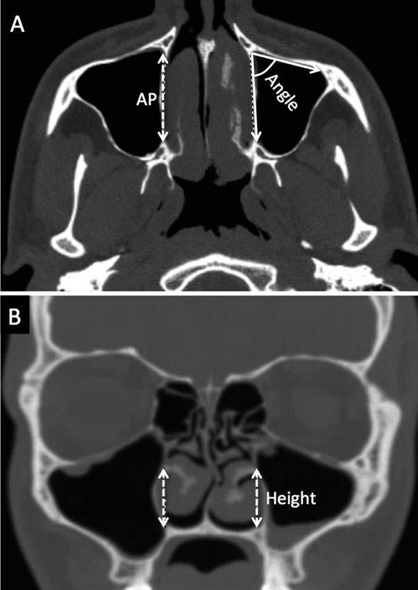 six patients in the case series. All imaging was reviewed: 26 scans used 1.25-mm axial cuts, one was 0.6 mm, two were 1.0 mm, two were 2.0 mm, three were 2.5 mm, two were 3.