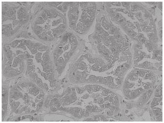 1490 CAI et al: ROLES OF SNAIL AND E-CADHERIN IN CLEAR CELL RENAL CELL CARCINOMA Snail expression and E-cadherin repression in clear cell renal cell carcinoma (CCRCC) are rarely studied.