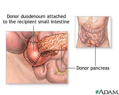 Pancreas transplantation -Not always curative!