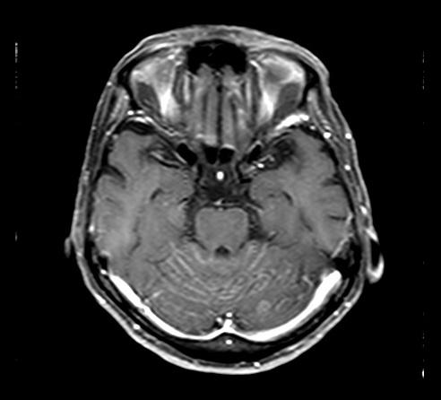 C: Gadolinium-enhanced T1-weighted brain image showed multiple brain metastases. C Fig. 2.