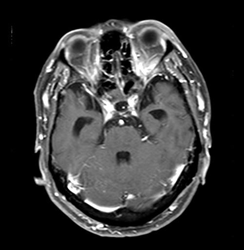 rain MRI images of Case 2 after CM : Gadolinium-enhanced