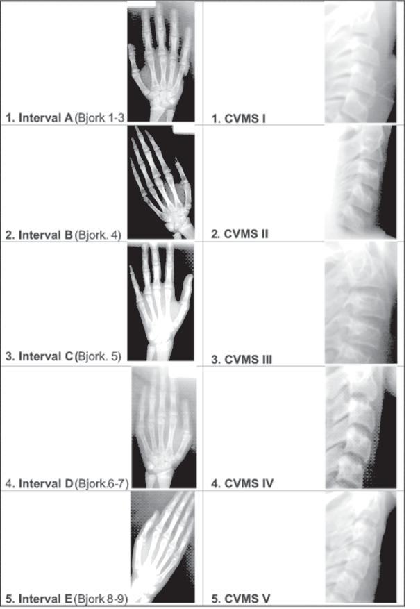Fig : Five growth intervals in hand-wrist