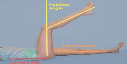 Evaluation Monitoring - popliteal angle used to measure hamstring contracture Normal popliteal angles -