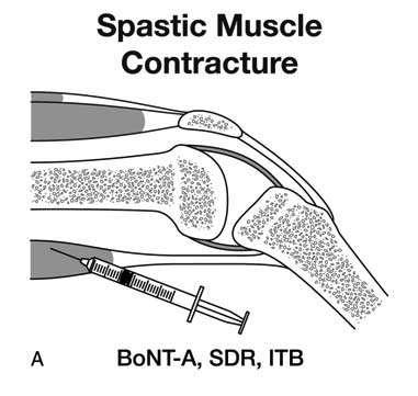 Orthotics Spasticity