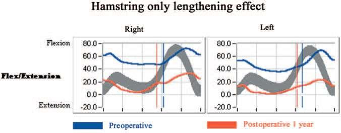 Example Hamstring lengthening alone The knee more
