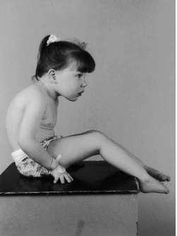 Natural History early childhood Hamstring contractures - in early childhood Sitting children : the inability