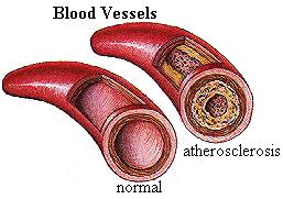 Heart Disease Atherosclerosis progressive narrowing of